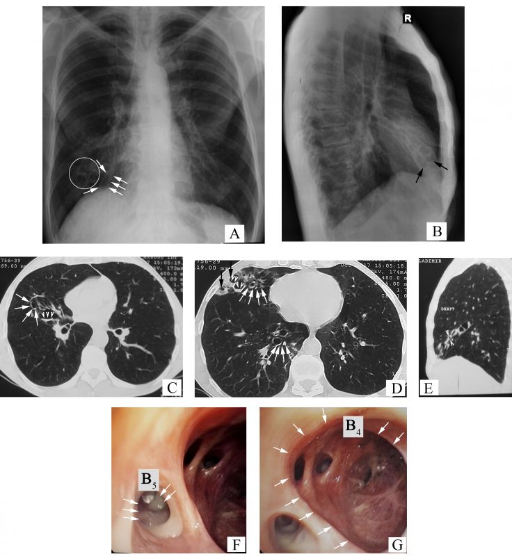 Fishad CP on LinkedIn: Bronchographic image showing? HRCT chest (lung  window) showing? What is…