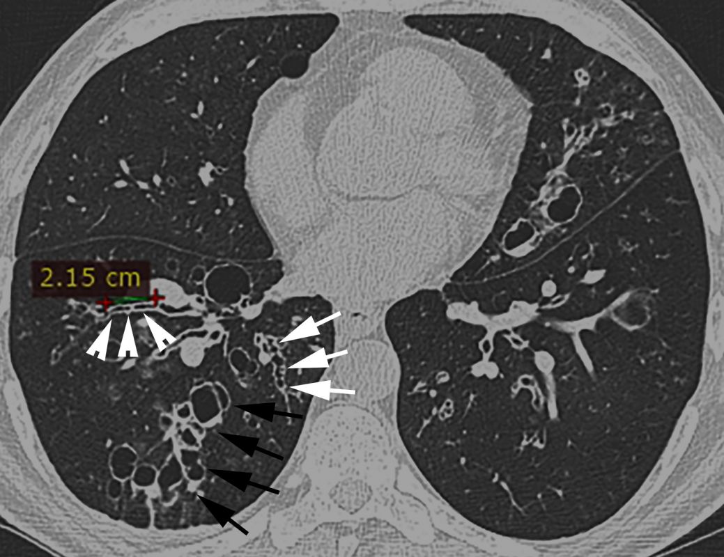 Bronchiectasis: Mechanisms and Imaging Clues of Associated Common and  Uncommon Diseases | RadioGraphics